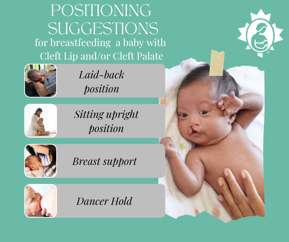 Feeding a Baby with a Cleft Lip and/or Cleft Palate La Leche League Canada Breastfeeding